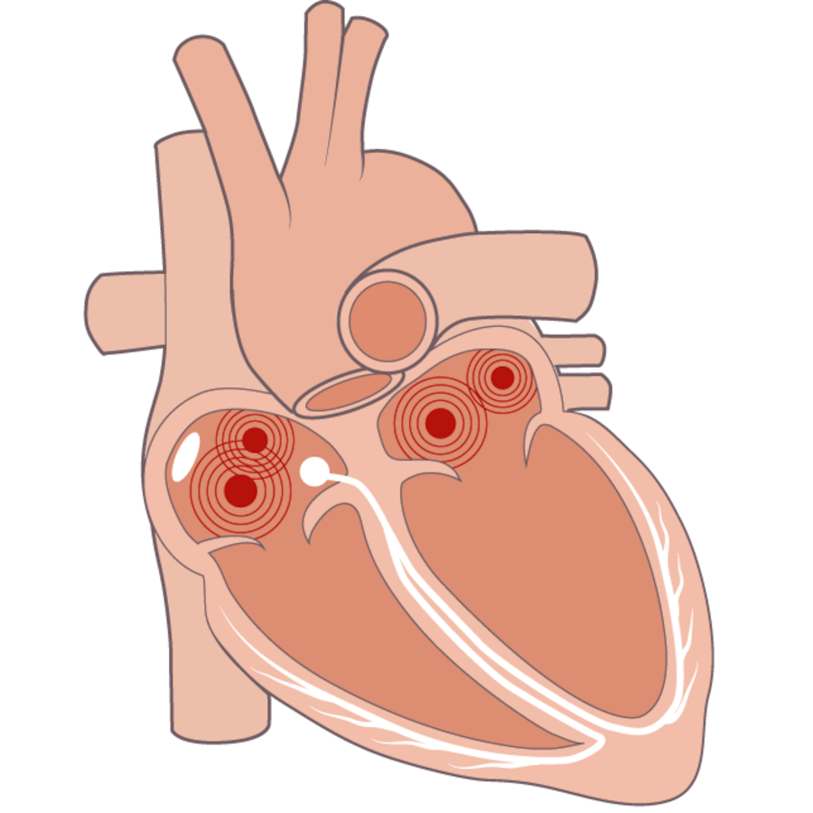 Grafische Darstellung, was beim Vorhofflimmern passiert.